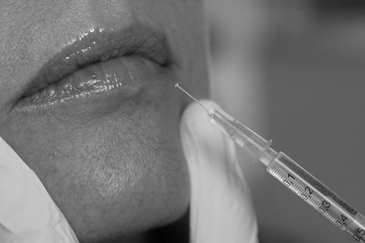 Anti-wrinkle treatment injected to a young woman's lips.