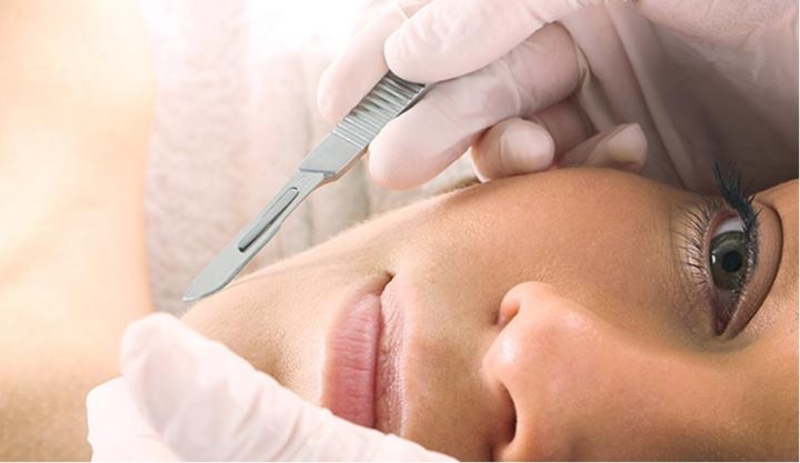 dermaplaning